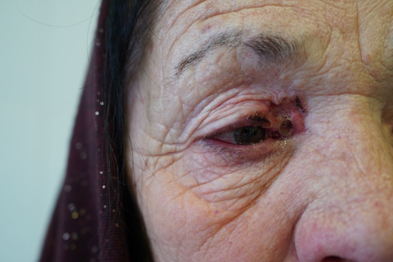 Врачи онкоцентра впервые применили для лечения рака кожи фотодинамичную терапию - Файл 1