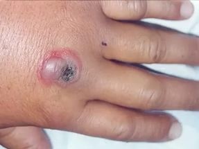 Пятеро пациентов с подозрением на сибирскую язву госпитализированы в больницу в с. Гурбуки